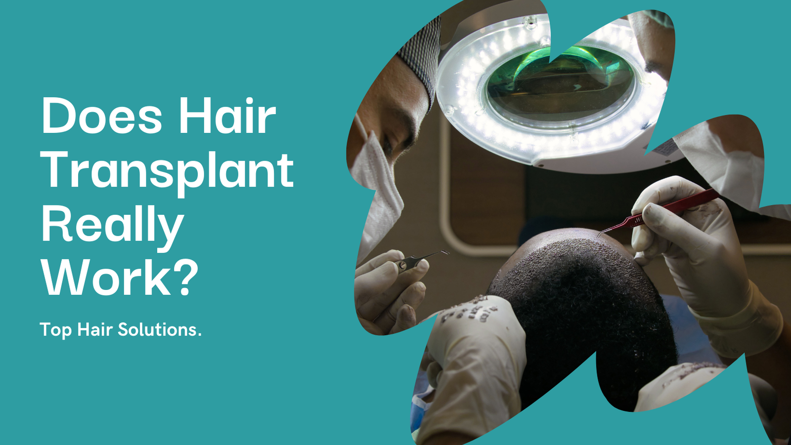 Does Hair Transplant Work? Effectiveness, Side Effects, and Recovery